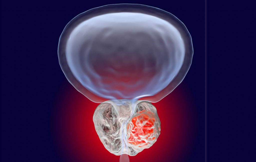 cancer prostata cancer prostata